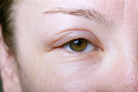 allergic reaction  hair dye face swelling fantasy diary gallery