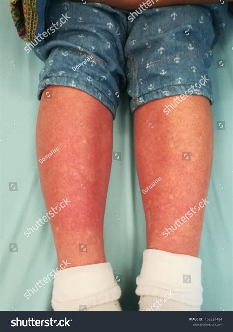 Typical Rashes After Recover Infection Dengue ภาพสต็อก 1153224484 ...
