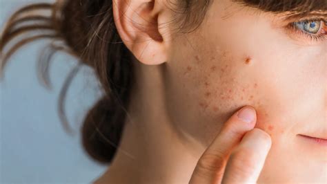 O Que Pode Causar Espinhas - ESPREMER ESPINHAS PODE CAUSAR INFECÇÕES GRAVES E ATÉ MENINGITE, ALERTAM ...