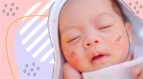 Акне у новорожденных: что нужно знать молодым родителям? | Здоровье.ру