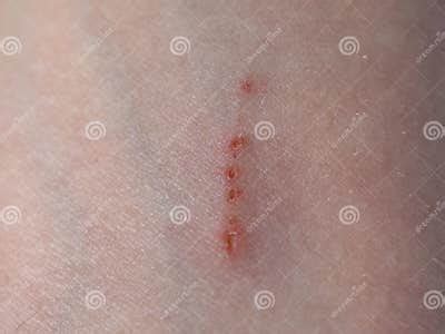 The Scar Predicter: 5 Signs A Scratch Will Leave A Permanent Mark