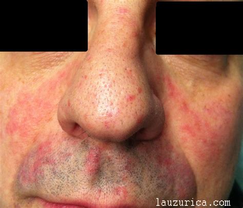 Dermatitis Seborreica En La Cara Tratamiento Eficaz Para La Dermatitis