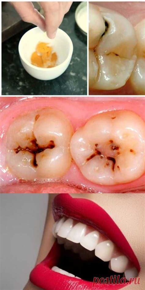 Полезные советы | Remedios para la salud, Caries, Salud