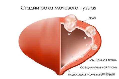 Рак мочевого пузыря стадии, типы и симптомы