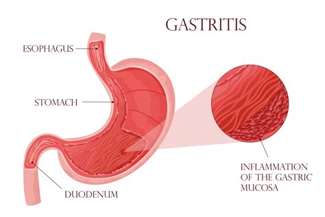 Rezepte Bei Gastritis 2