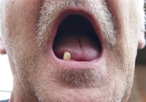 What To Eat With No Teeth? (Easy And Healthy Recipes)