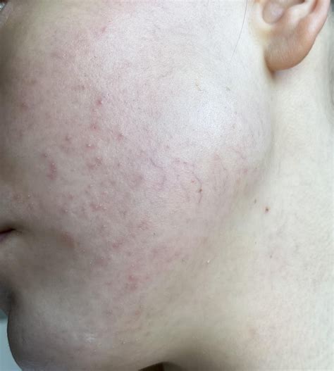 Skin bumps : r/DermatologyQuestions