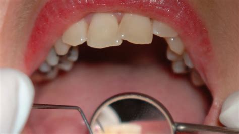 The whole tooth: Five fascinating dental facts | ITV News Central