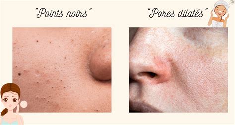 acne solution radicale nonprescription acne treatment  products