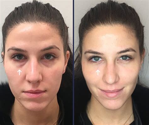 injections  dark circles