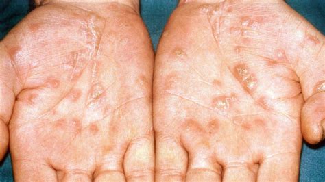 syphilis  deadly disease  spread  australia bbc news