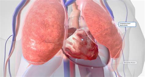 Congestive Heart Failure Signs and Symptoms Stock Illustration ... 