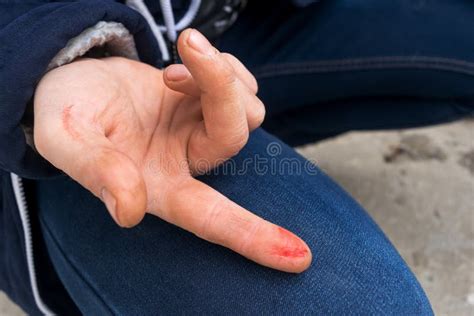 Bloody Wound on the Finger. Cut the Skin Stock Photo - Image of scar ...