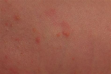 Сыпь у новорожденных: опасные и безопасные высыпания, милии, акне ...