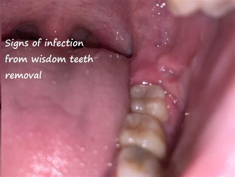 how to know if you have teeth infection