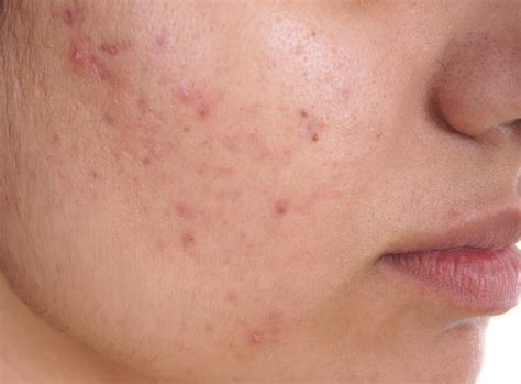 Acne: Causes, treatment, and tips