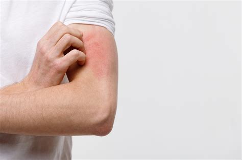 Top 8 Herbs To Treat Collagen Vascular Disease | Be Herbal® Articles on ...