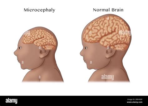Small Head Syndrome Adult