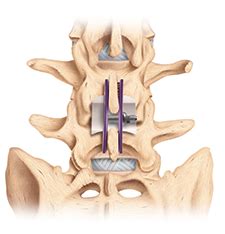 MIS ILIF (Interlaminar Lumbar Instrumented Fusion) | Swift Institute