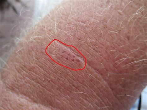 Caterpillar Sting Treatment - Catalog Library