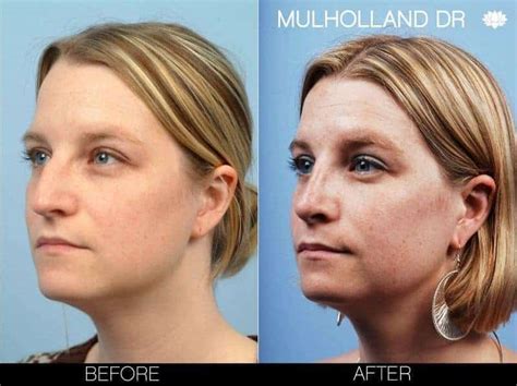 Rhinoplasty for Bulbous Nose Tip: Causes & Treatment