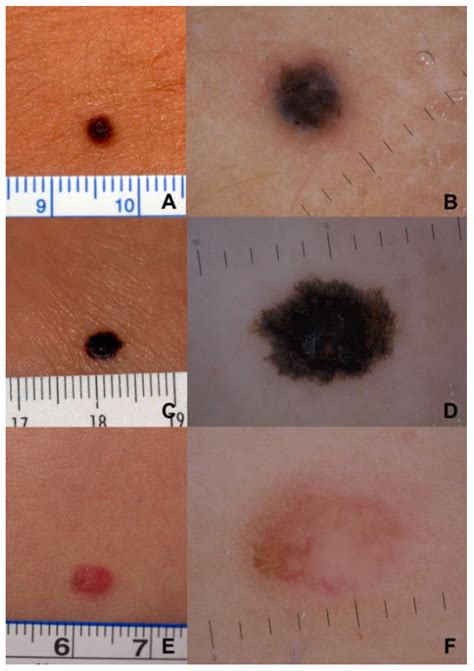 Melanoma Jinak at Caitlin Gilles blog