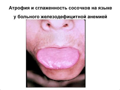 Железодефицитные, витамин В12 и фолиеводефицитные анемии - презентация ...