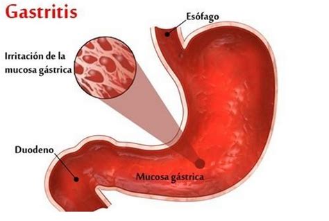 Acute Gastritis Symptomen, Oorzaken, Diagnose Medikamio, 60% OFF