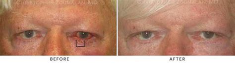 Eyelid Skin Cancer Beverly Hills | Mohs Surgery Los Angeles