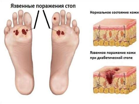 Лечение. Общее и местное лечение СДС - online presentation