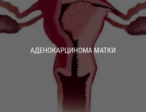 Аденокарцинома матки: симптомы, причины, лечение, прогноз на жизнь ...