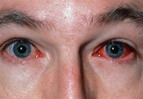 viral conjunctivitis eye disorders merck manuals professional edition