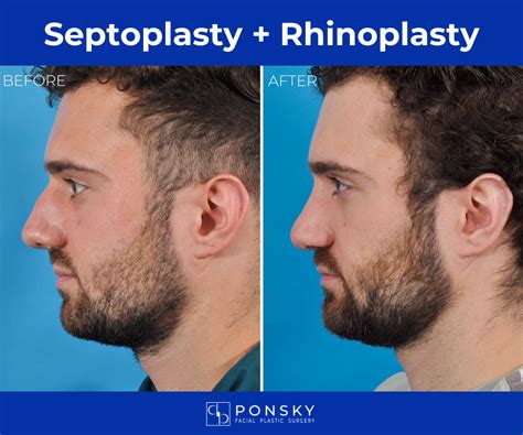 deviated septum surgery