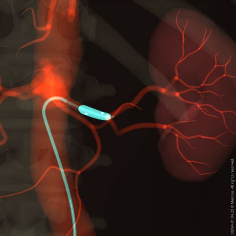Renal Denervation | Software