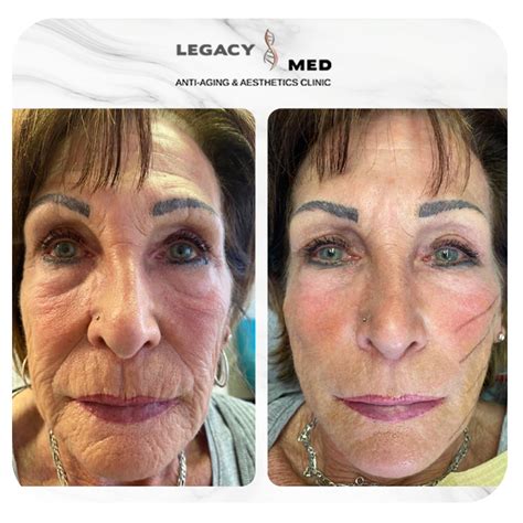 Lifting facial cu fire PDO - Legacy Med