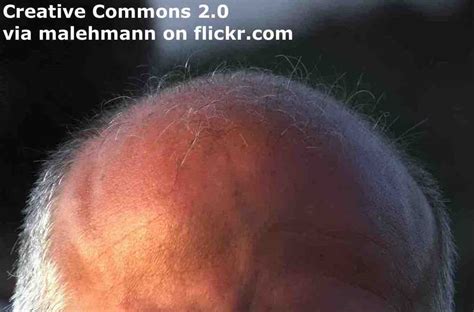 breaking news english dictation baldness