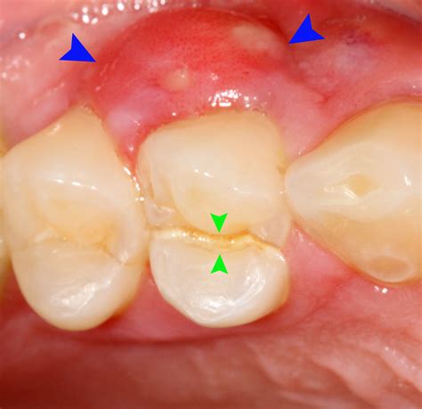 Abscessed Tooth Removal