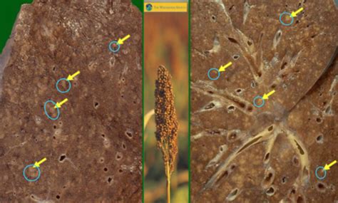 Mycobacteria Flashcards | Quizlet 