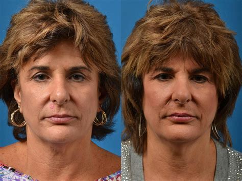 Patient 122406411 | Mohs Surgery and Skin Cancer Before & After Photos
