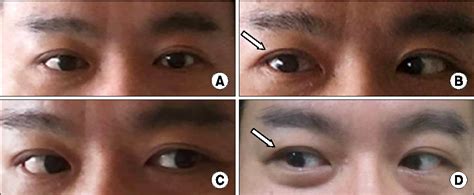 figure   epidural blood patch   treatment  abducens nerve
