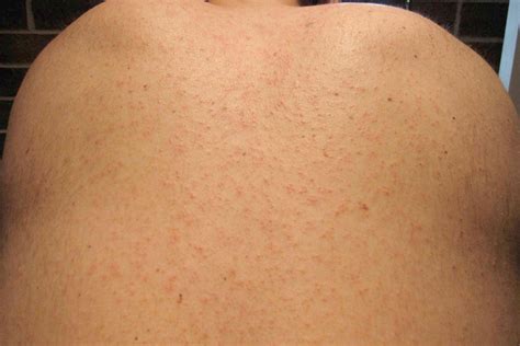 Measles Pictures Early Stages EMS Guide To Measles: Symptoms,