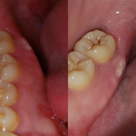 I can see a bone spur in my gums. What should I do? | News | Dentagama