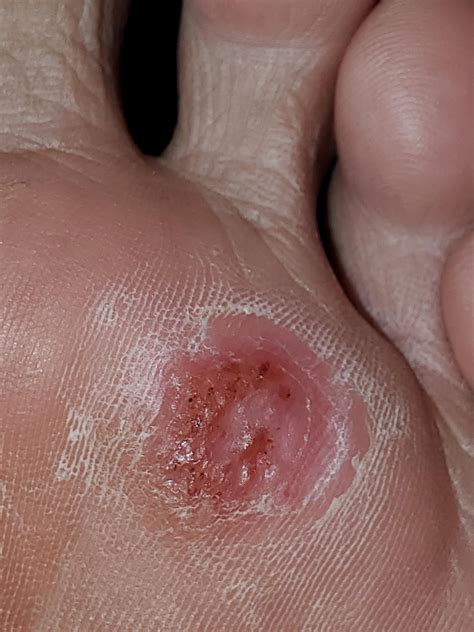 I've been using wart removing pads with SA for weeks. Finally decided