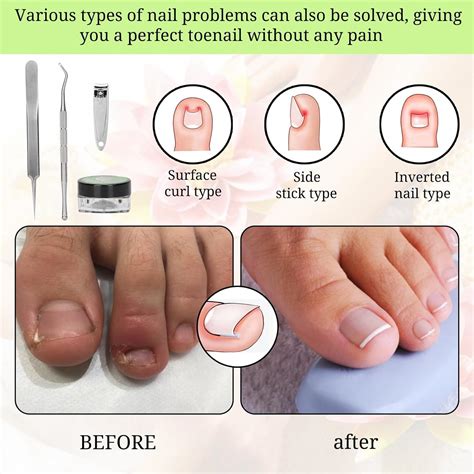 how to clip an ingrown toenail 4