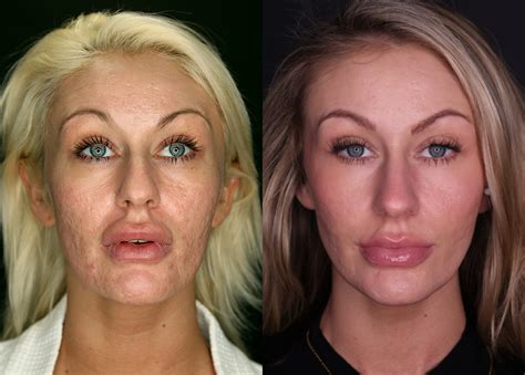 Acne Scars And Treatment at Lloyd Sutton blog