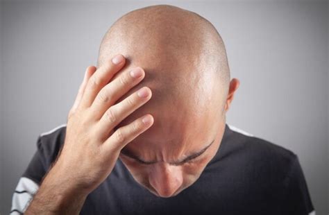 understanding male baldness   prevention