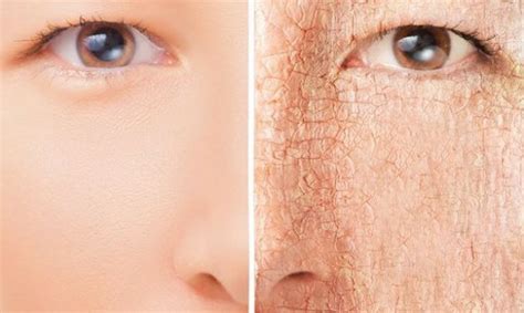 mengatasi kulit kering  expert terbukti ampuh