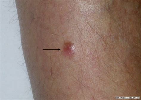 nodular melanoma pictures early - pictures, photos