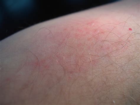 Bed Bug Black Marks at Christopher Dehart blog