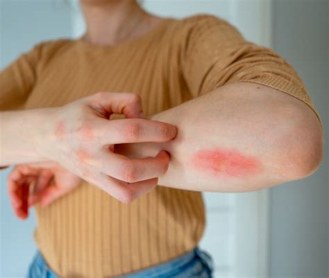 rash cutaneo  piu comuni  segni  cui fare attenzione